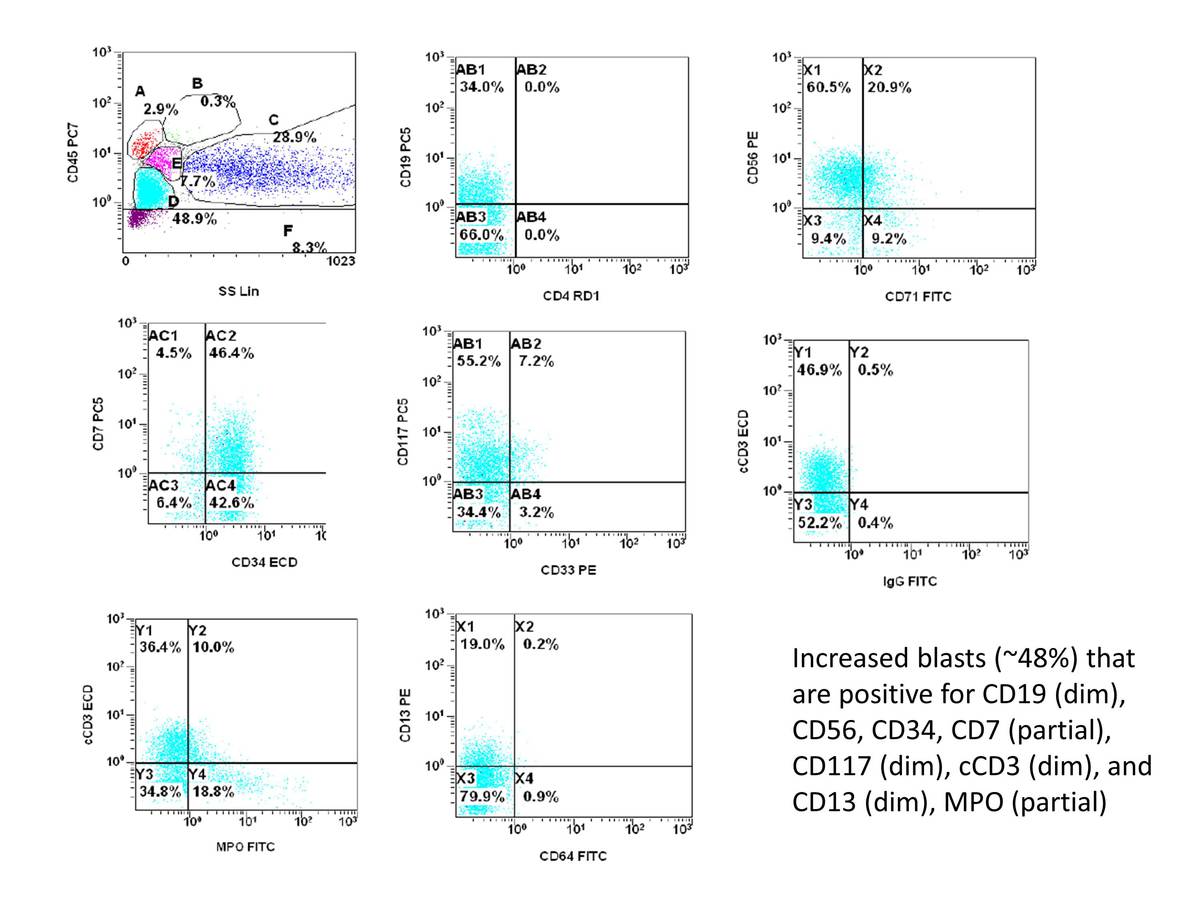 Increased blasts (~48%) that are positive for CD19 (dim), CD56, CD34, CD7 (partial), CD117 (dim), cCD3 (dim), and CD13 (dim), MPO (partial).